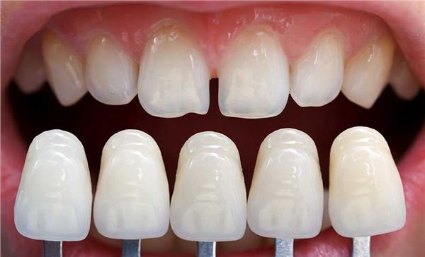 Empress (Full Porcelain)