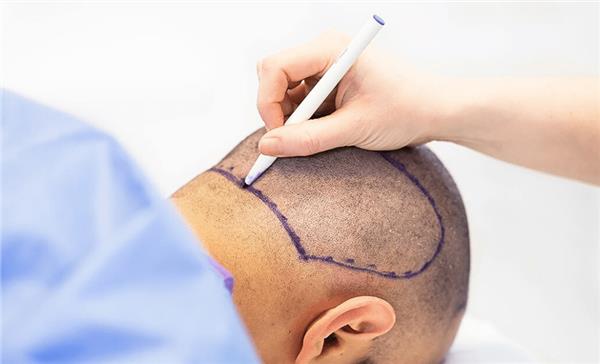 DHI Hair Transplant