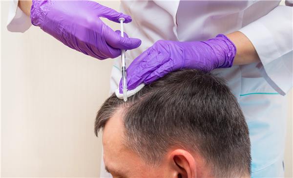FUE Hair Transplant
