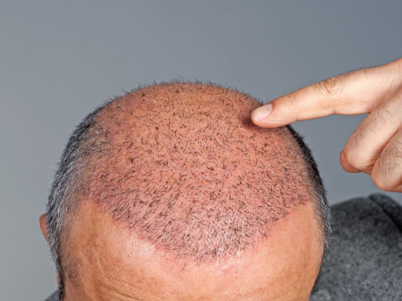 Is everyone suitable for hair transplantation?