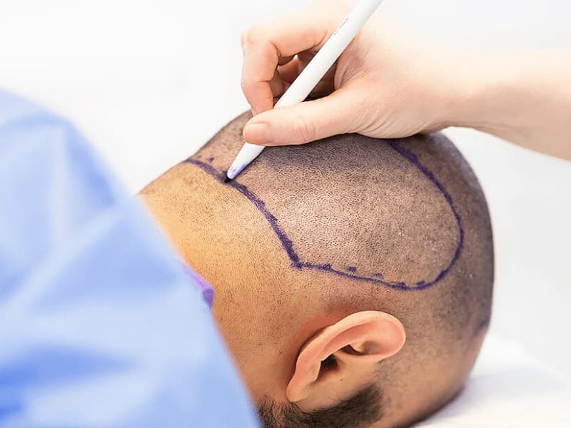 What are the side effects of hair transplantation?